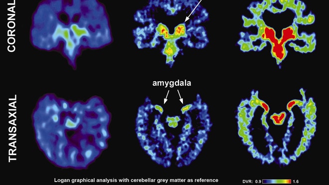 UCLA NFL brain scan.JPG